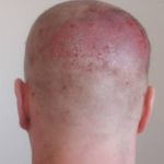 Donorgebiet nach der Entnahme von etwa 3.000 Graft-Haaren - Haartransplantation Erfahrungen eines Patienten