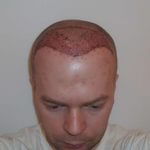 Kopfhaut Zielgebiet nach der Haartransplantation am Tag 1
