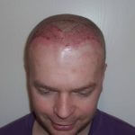 Kopfhaut kurz nach der Haarverpflanzung - Haartransplantation Erfahrungen eines Patienten