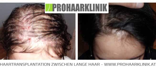 Haartransplantation Ergebnisse - Medium Bilder