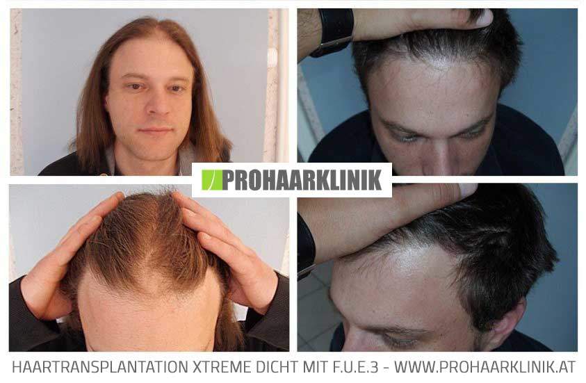 Haartransplantation Wien