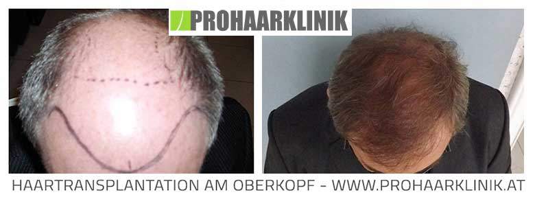 Haarverpflanzung, Haartransplantation