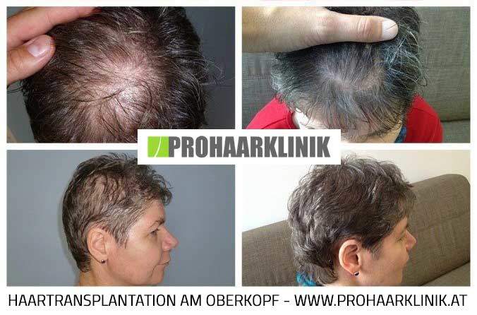 Haartransplantation Medium Fotos
