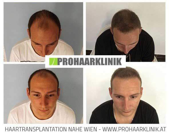 Haartransplantation, Haarimplantation