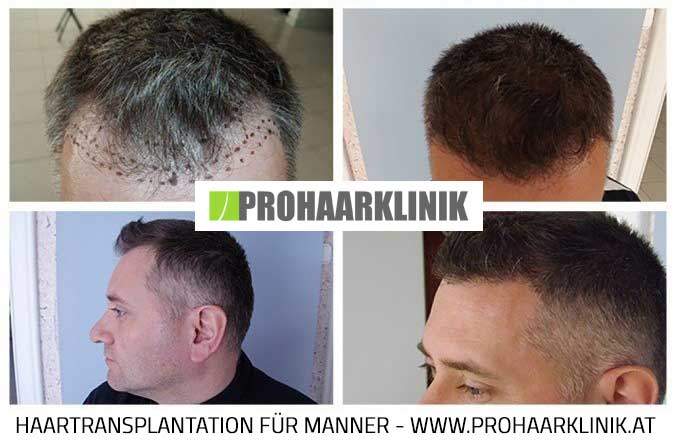 Haartransplantation vorher nachher - PROHAARKLINIK