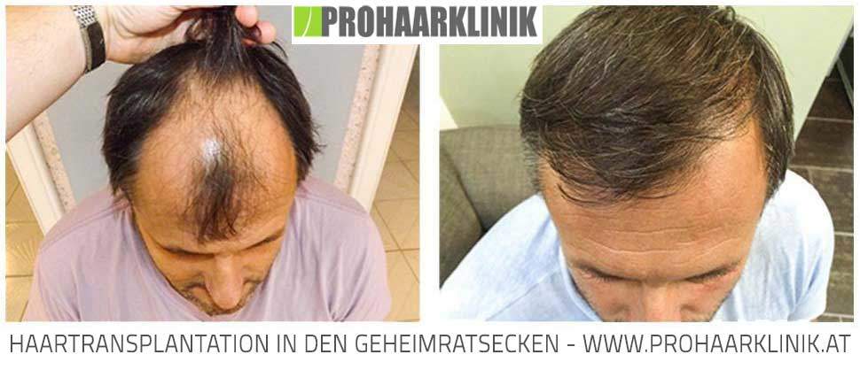 Haartransplantation mit FUE Method