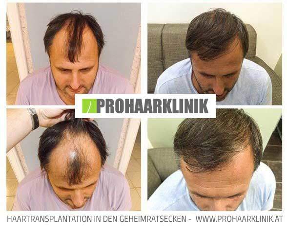 Haartransplantation, Haarimplantation Ergebnisse