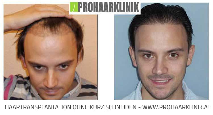 FUE Haartransplantation