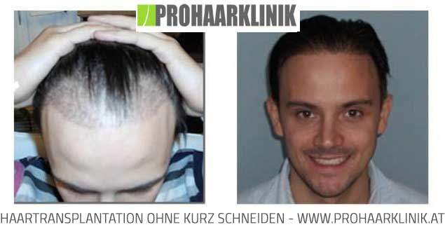 FUE Haartransplantation, Haarverpflanzung