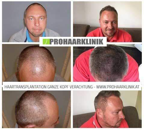 FUE Haartransplantation für Manner Bild