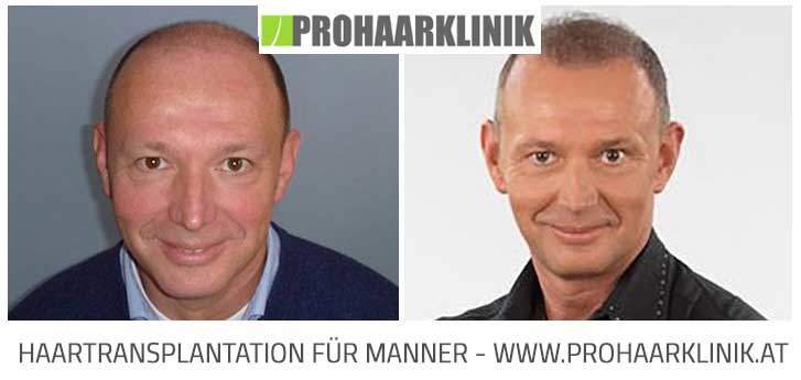 Haartransplantation Vorher Nachher