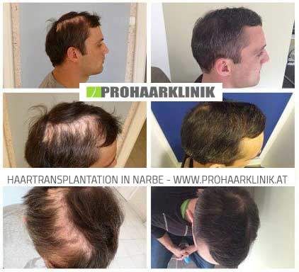 Haartransplanbtation mit 5000 Haare - Ergebnis Fotos