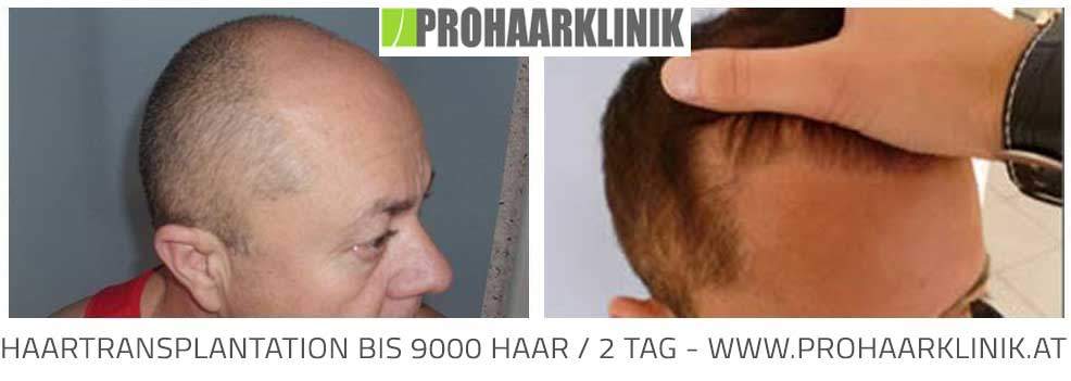 FUE Haartransplantation Technik - Vorher Nachher