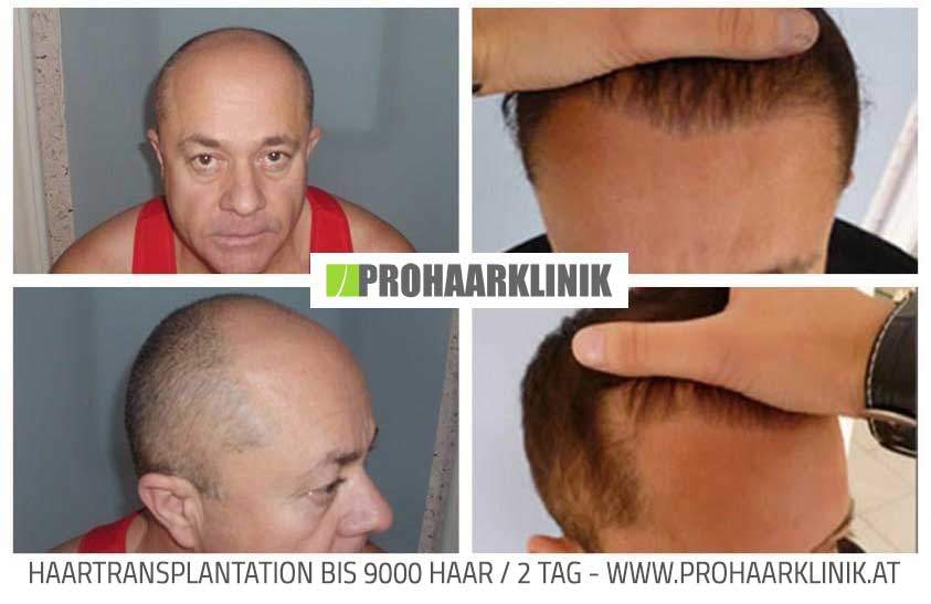Haartransplantation - Zoltan Cs.