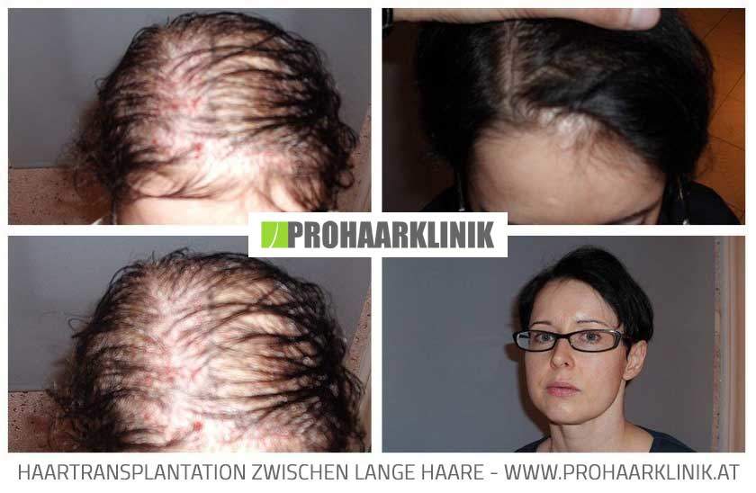 Haartransplantation vorher nachher Medium Fotos