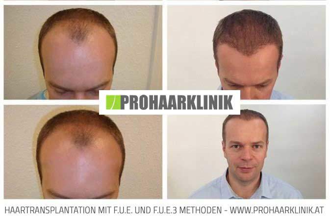 Haartransplantation Ergebnis von Thomas L.