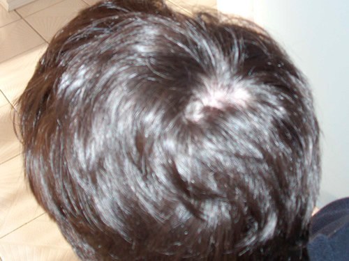 Ansicht von hinten vor der Haartransplantation