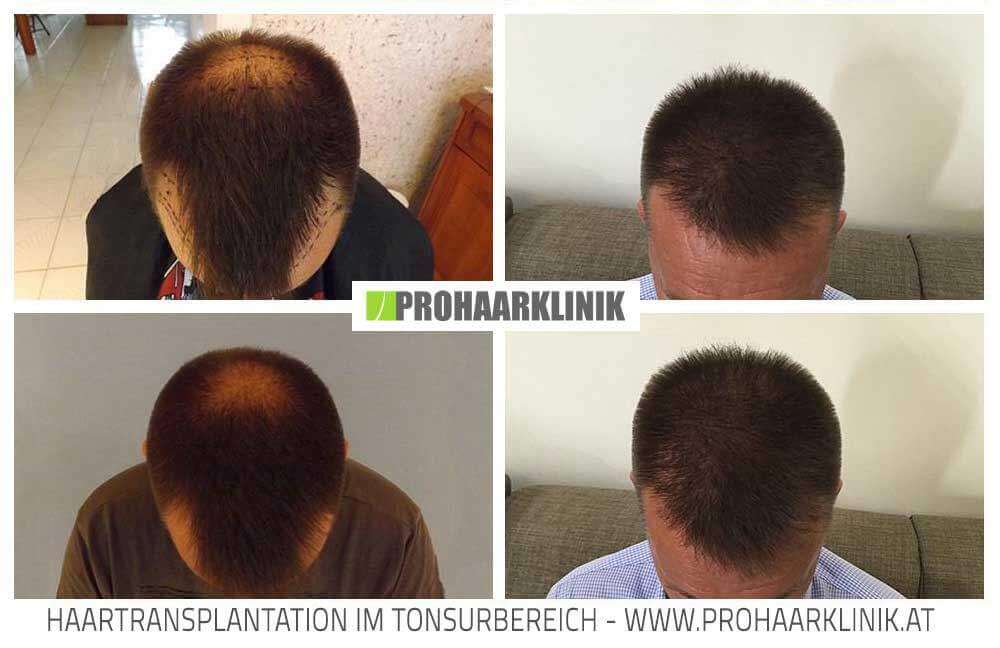 Fue Haarverpflanzung Vorher-Nachher Fotos Ergebnisse