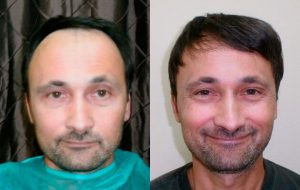 Haartransplantation mit Erfolg in der PROHAARKLINIK