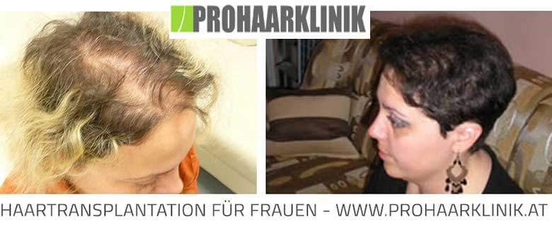 Fue Haarverpflanzung Vorher-Nachher Fotos Ergebnisse