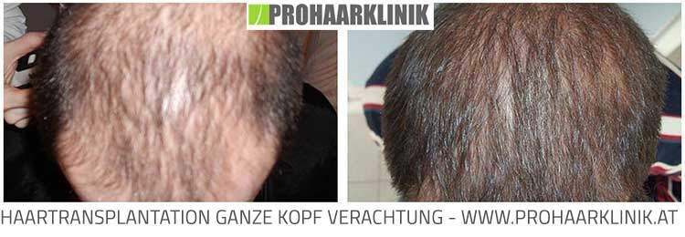 Haartransplantation für Manner - Ergebnis