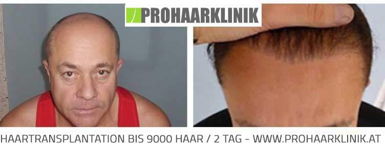 Haartransplantation - 9000 Haar