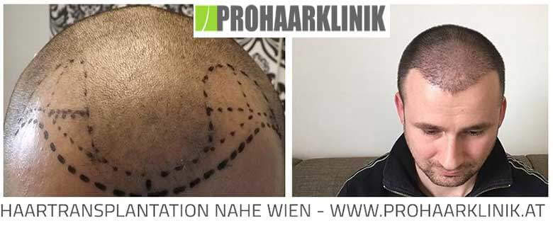 Haartransplantation nahe Wien