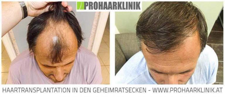 Haartransplantation Vorher Nachher - Deutschland