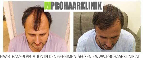 FUE Haartransplantation Ergebnisse - Deutschland