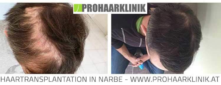 Haartransplantation, Haarverpflanzung