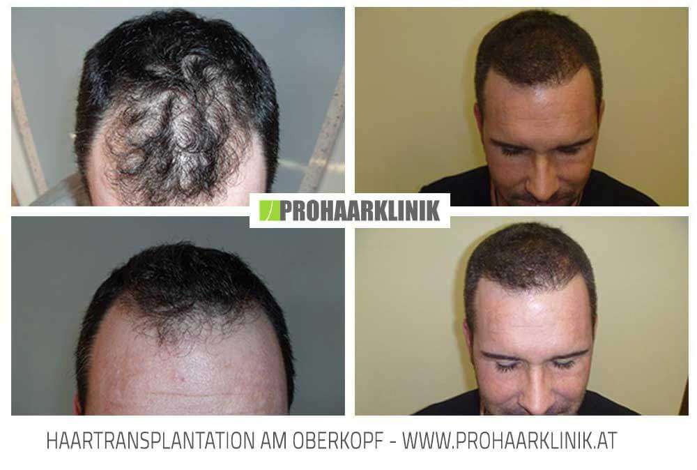 Haartransplantation, Haarverpflanzung vorher nachher