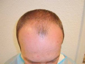 Geheimratsecken was tun? Haartransplantation als Lösung