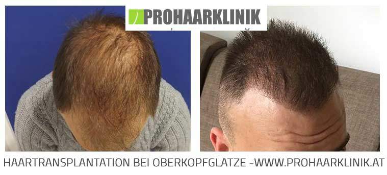 FUE Haartransplantation Ergebnis