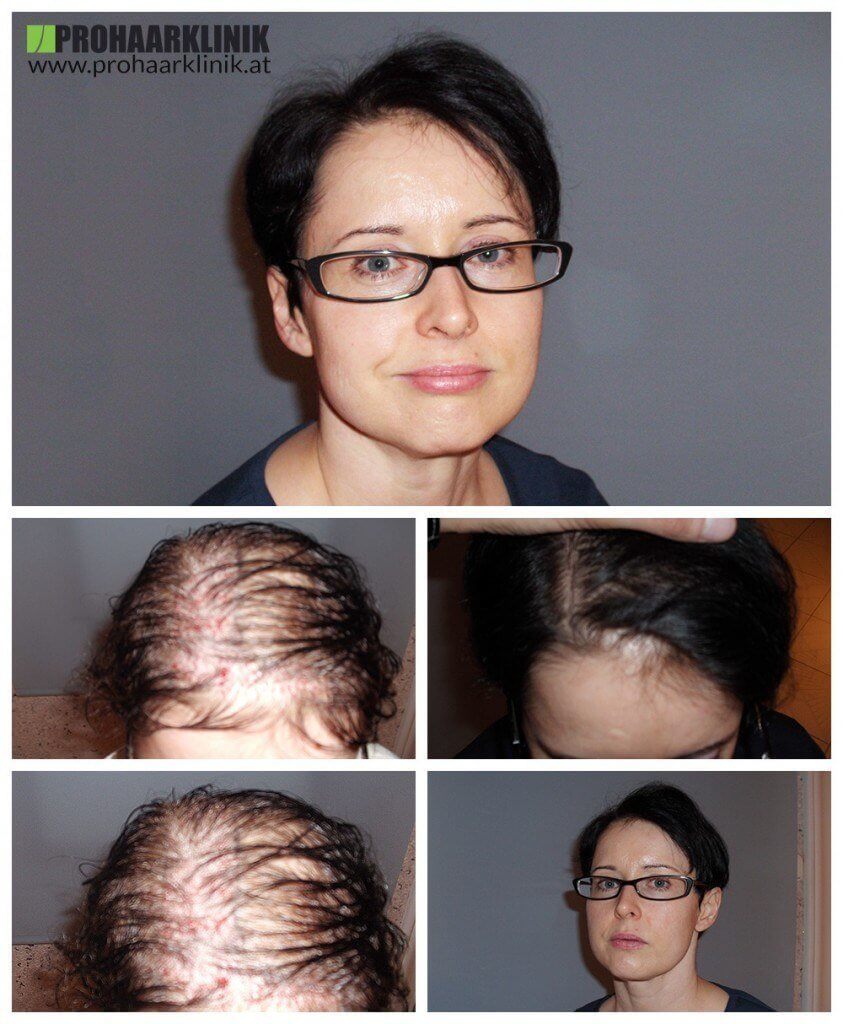 Haartransplantation Hannover Frauen vohrer nachher Haarverpflanzung