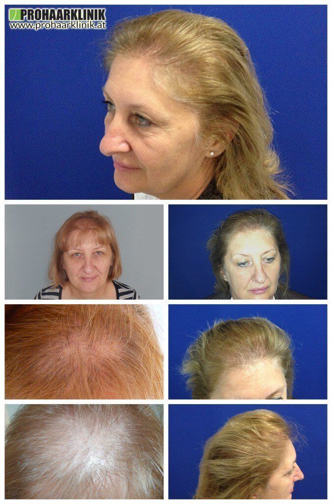 Haartransplantation Liestal Frauen vohrer nachher Haarverpflanzung