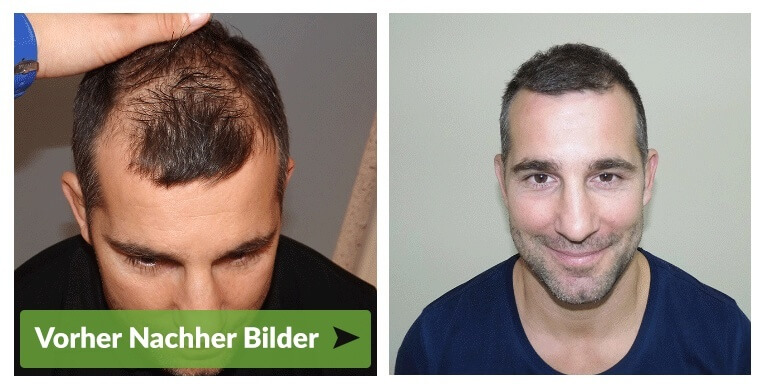 Haartransplantation Bellinzona vohrer nachher Haarverpflanzung