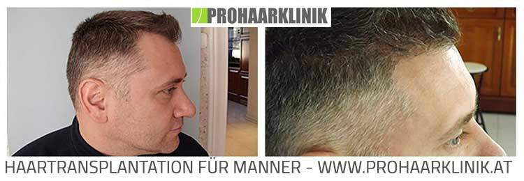 Fue Haartransplantation Vorher-Nachher Fotos Ergebnisse