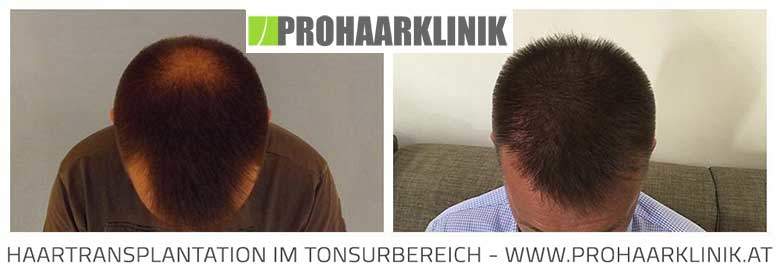 Fue Haartransplantation Vorher-Nachher Fotos Ergebnisse