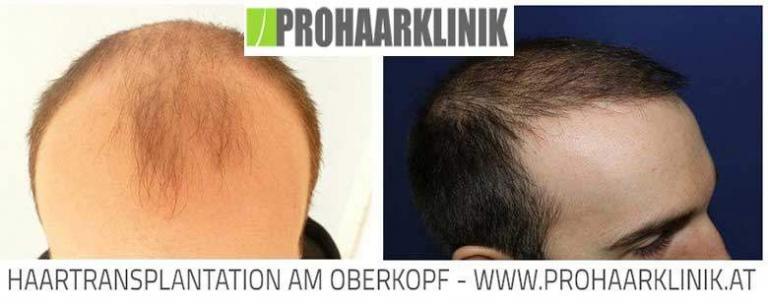 Fue Haartransplantation Vorher-Nachher Fotos Ergebnisse