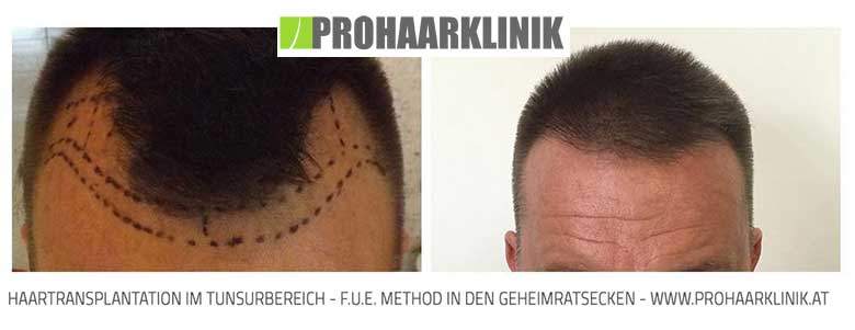 Fue Haartransplantation Vorher-Nachher Fotos Ergebnisse