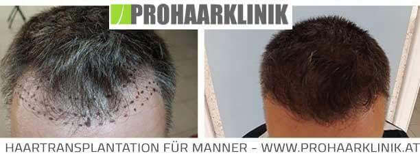 Fue Haartransplantation Vorher-Nachher Fotos Ergebnisse