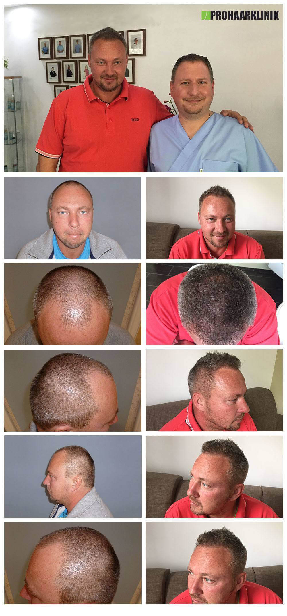 Haartransplantation Vorher Nachher