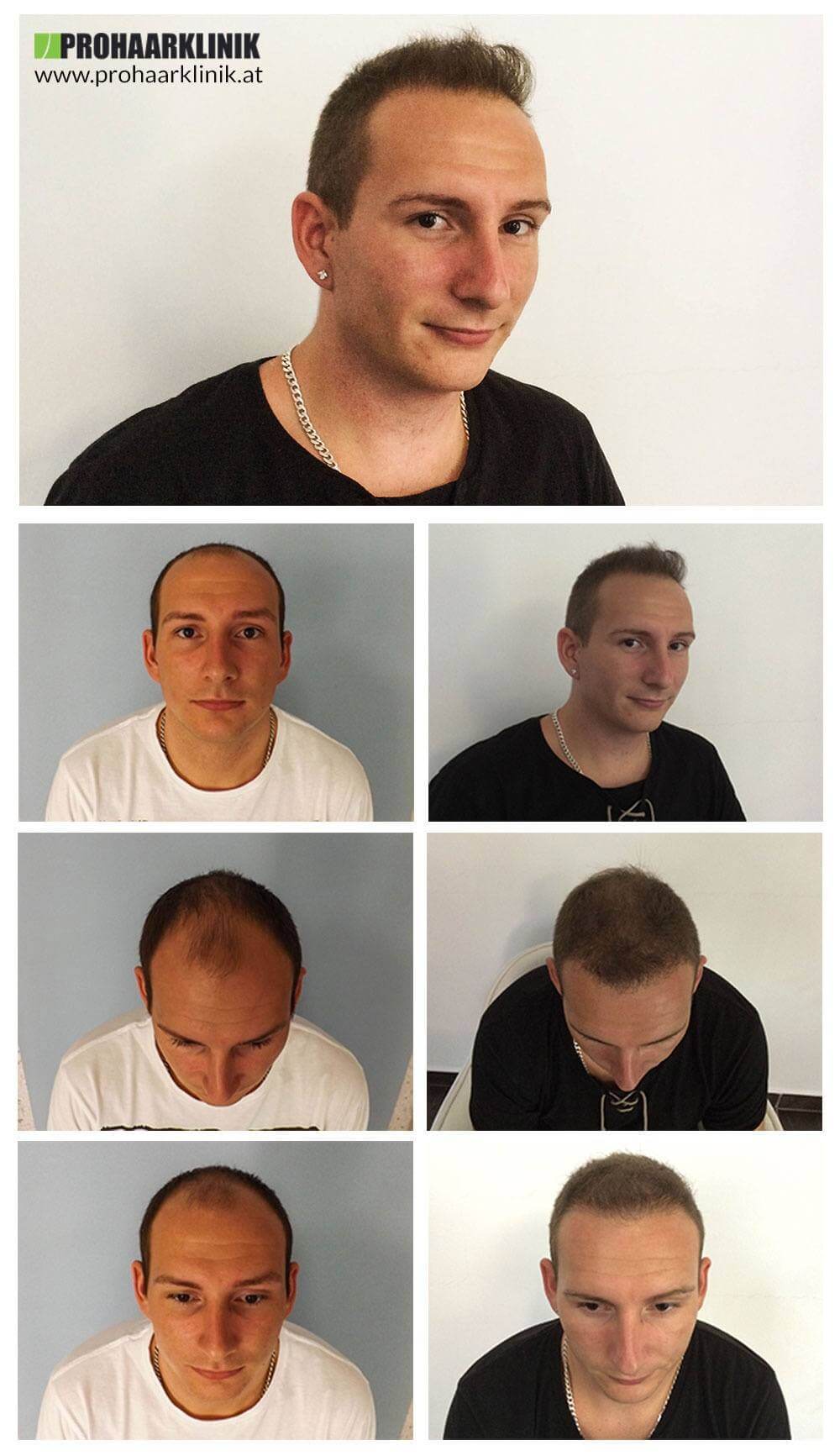 Haartransplantation Vorher Nachher Bilder Der Prohaarklinik Ungarn