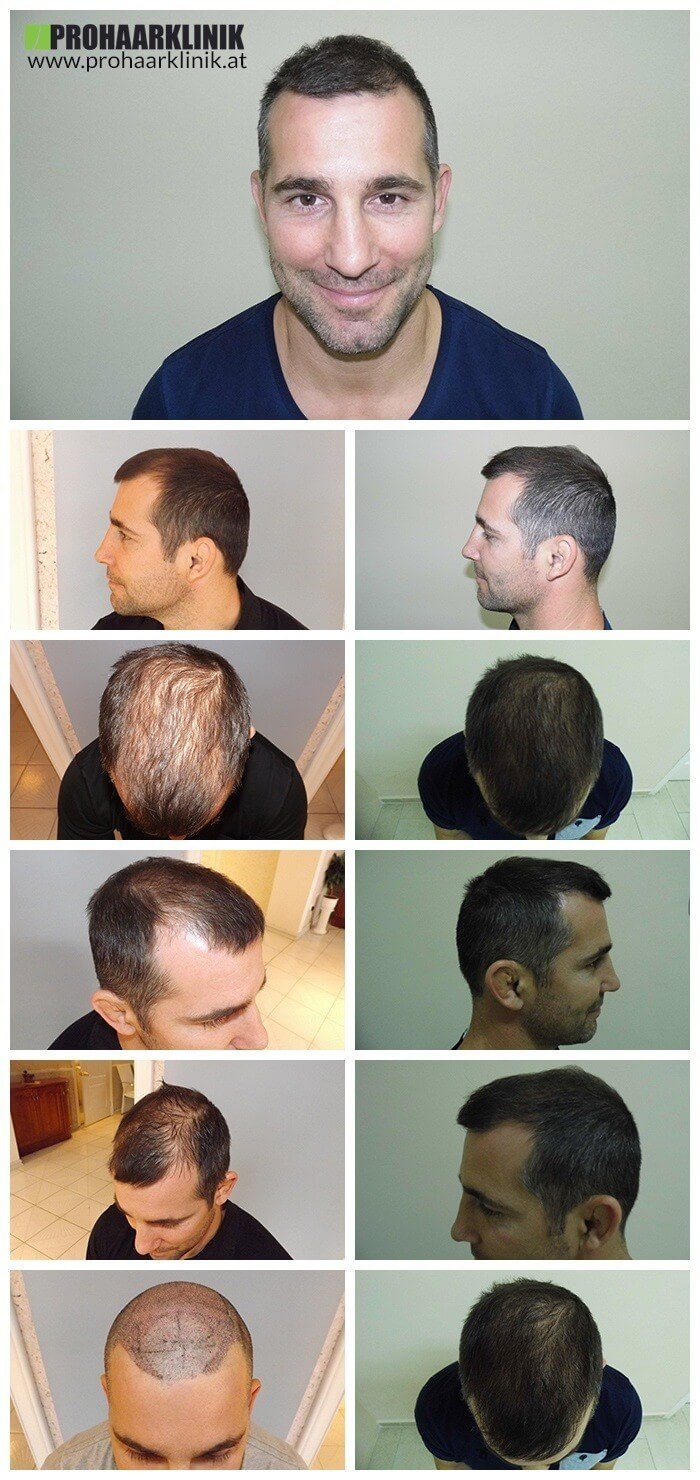 Haartransplantation Vorher Nachher