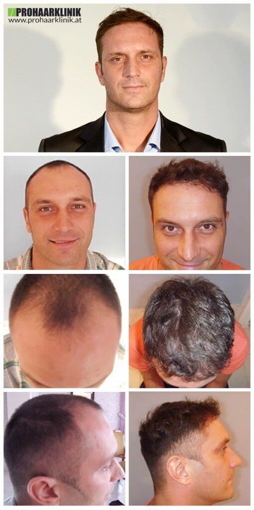 Haartransplantation Vorher Nachher