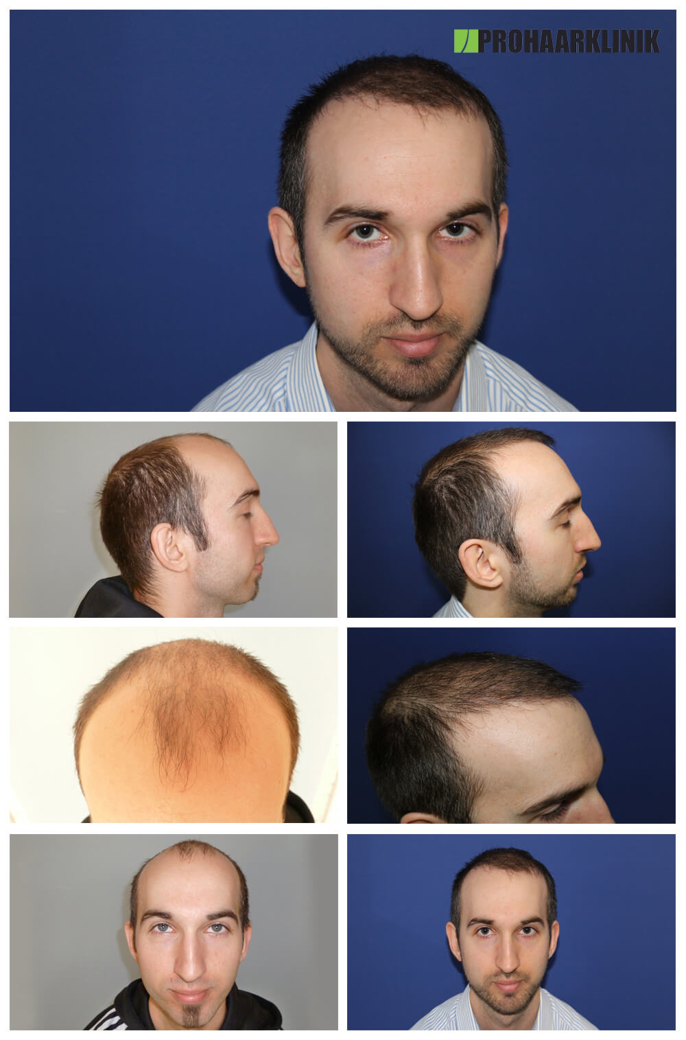 Haartransplantation Vorher Nachher