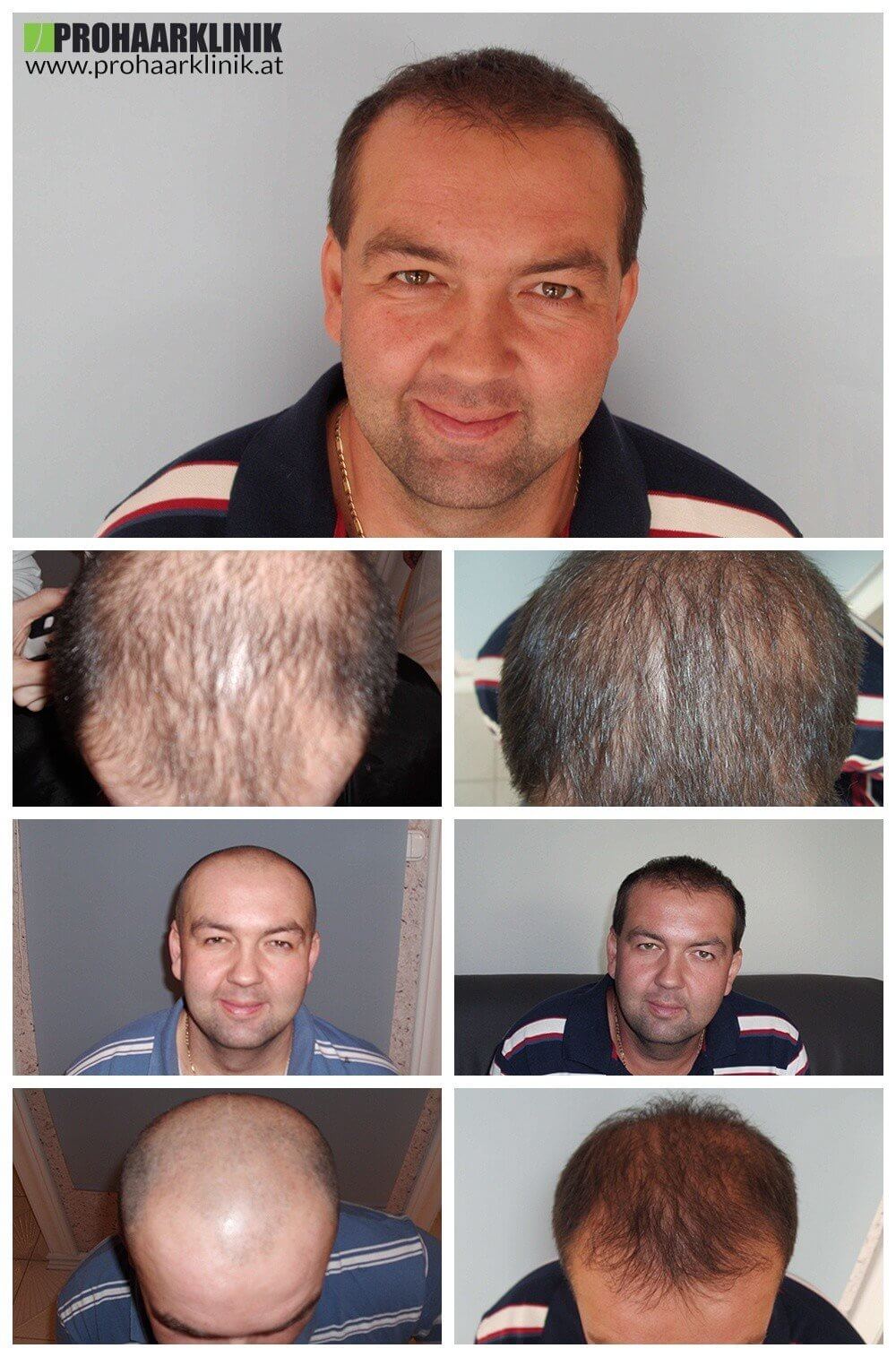 Haartransplantation Vorher Nachher