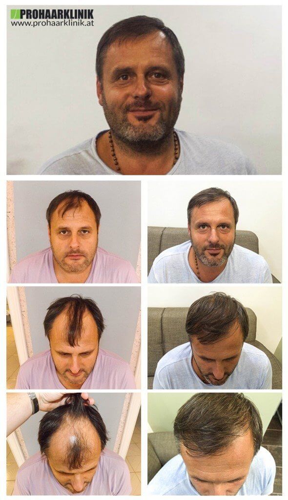 Haartransplantation Vorher Nachher