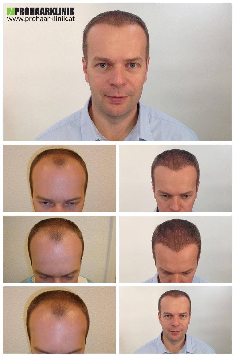 Haartransplantation Vorher Nachher