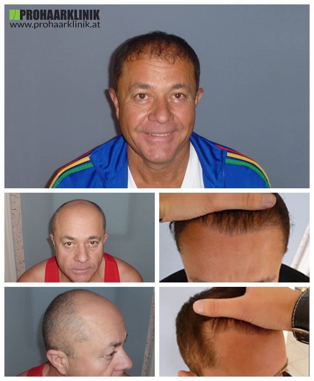 Haartransplantation Vorher Nachher